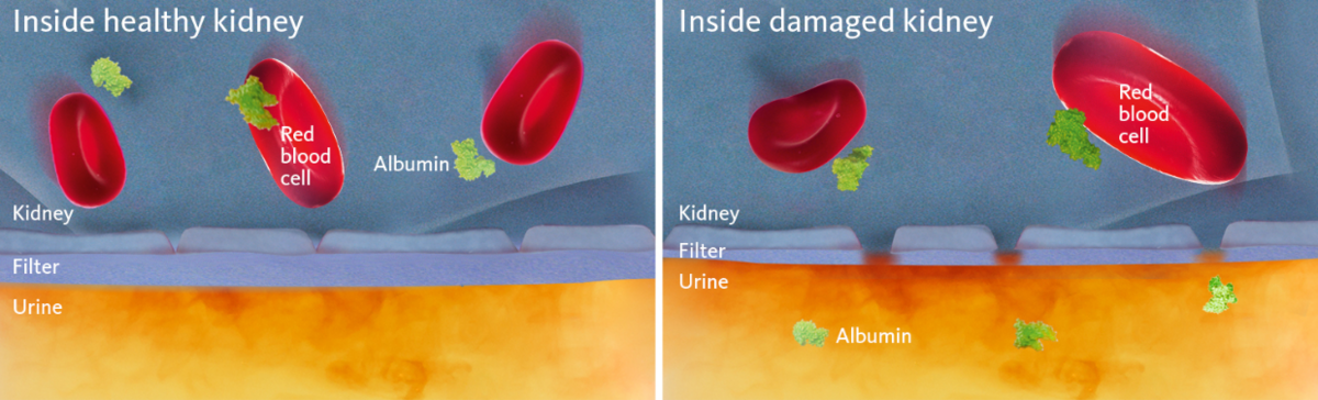 [.ZA-en South Africa (english)] •	Schematic and simplified view of a healthy and a damaged kidney membrane with the latter illustrating the cause of albuminuria.